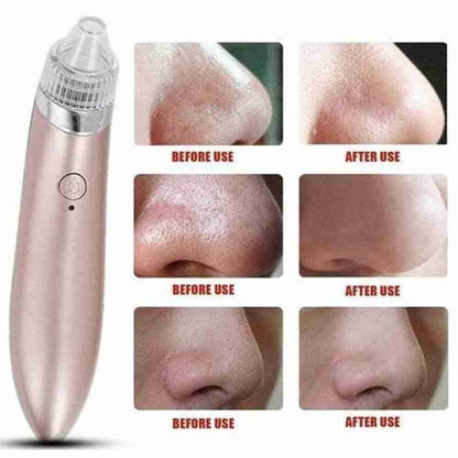 Limpiador De Puntos Negros Facial Almalux®
